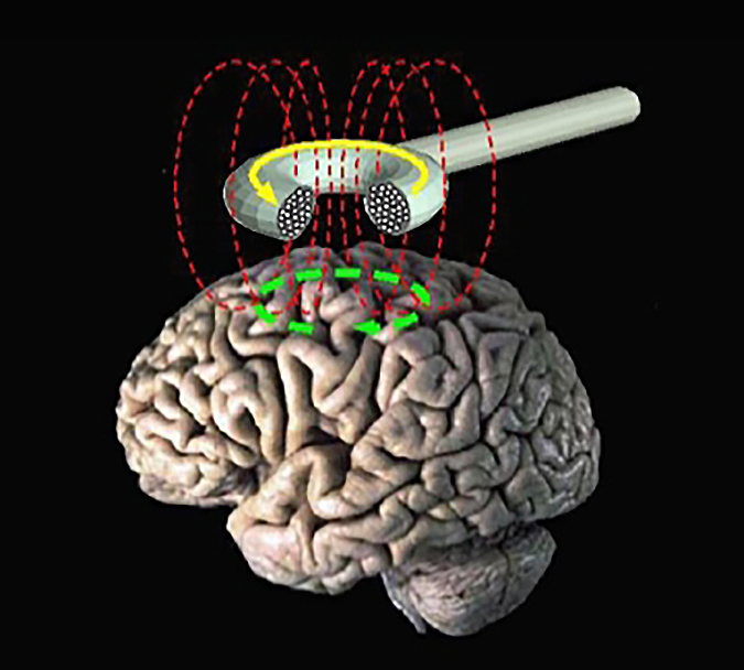 Repetitive transcranial stimulation (rTMS) a cuttingedge neuropsychiatric therapy